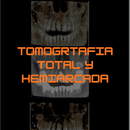 Tomografía total y hemiarcada